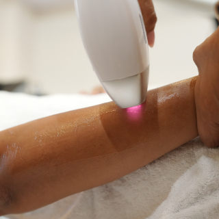 Best Permanent Hair Removal Laser